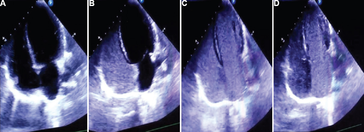 Transthoracic echocardiographic images: (A) the normal cardiac chambers, septa and valves. (B) Image of saline contrast echocardiograph after injection of agitated saline, the contrast bubbles are seen in the right chamber of the heart. (C) Image after three cardiac cycles, where the bubbles appear in the left chamber of heart and (D) Further build-up of contrast bubbles in the left chamber while diminishing from the right chamber.